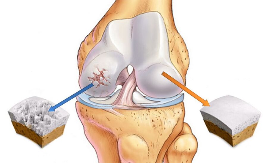 Osteoarthritis of the knee joint and healthy cartilage. 