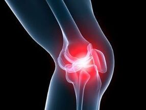 Osteoarthritis of the knee joint causing knee pain. 