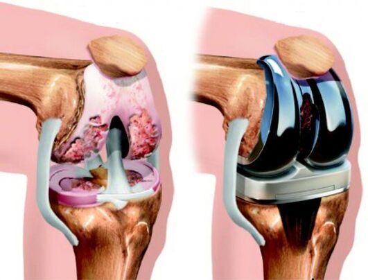 Result of knee replacement surgery for osteoarthritis