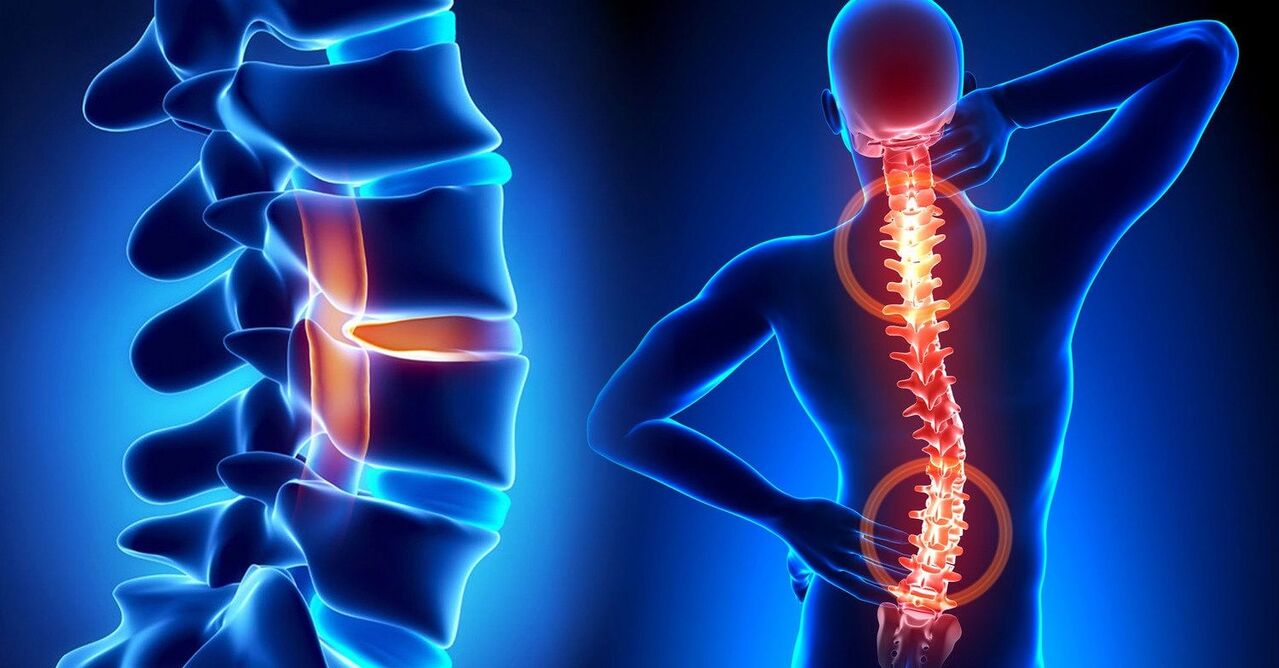 a diseased spine causes neck problems