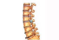 Stages of Cervical Osteochondrosis Development