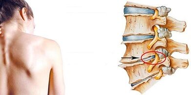 The development mechanism of cervical osteochondrosis