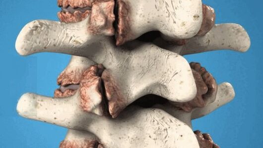 Osteophytes of the vertebrae pathological growths that damage nerves and blood vessels