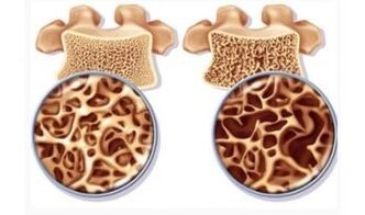 Cervical suction danger for women
