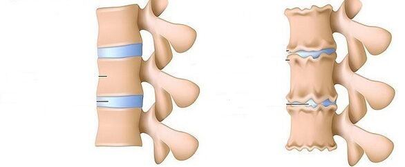 Healthy column and osteochondrosis