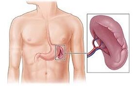 pathology of the spleen as a cause of pain under the left shoulder blade