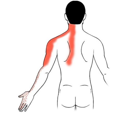 Cervical osteochondrosis as a cause of pain in the joints of the fingers
