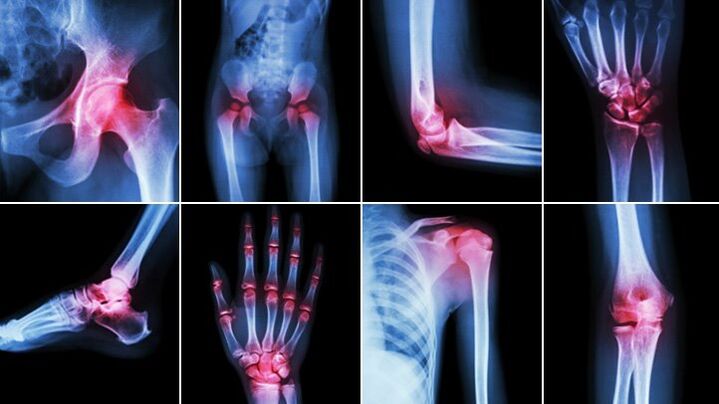 body joints affected by osteoarthritis